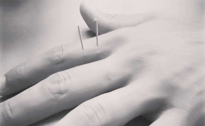 Learn About Acupuncture Ancient Wisdom Modern Relevance